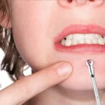 Ferretto Pulizia Viso Uomo Donna Rimuovi Brufoli Acne Punti
