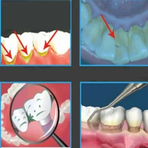 Pulizia Dei Denti Ad Impulsi Sonici Tartaro Macchie Dentali