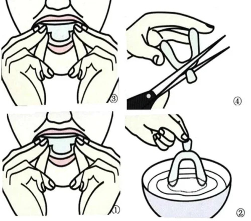 4 Pezzi Silicone Dentale Notte Aiuto Sonno Sbiancamento