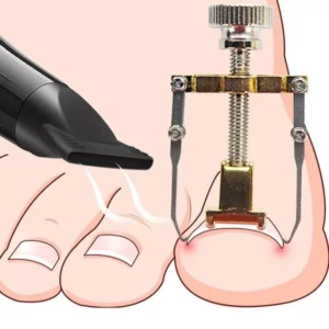 Pedicure Strumento Correzione Correttore Unghia Incarnita