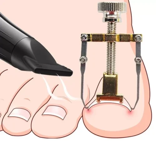 Pedicure Strumento Correzione Correttore Unghia Incarnita