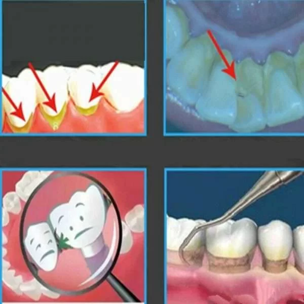 Pulizia Dei Denti Ad Impulsi Sonici Tartaro Macchie Dentali Placca Sbiancamento