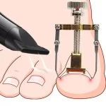 Pedicure Strumento Correzione Correttore Unghia Incarnita Alluce Piede Rimedio